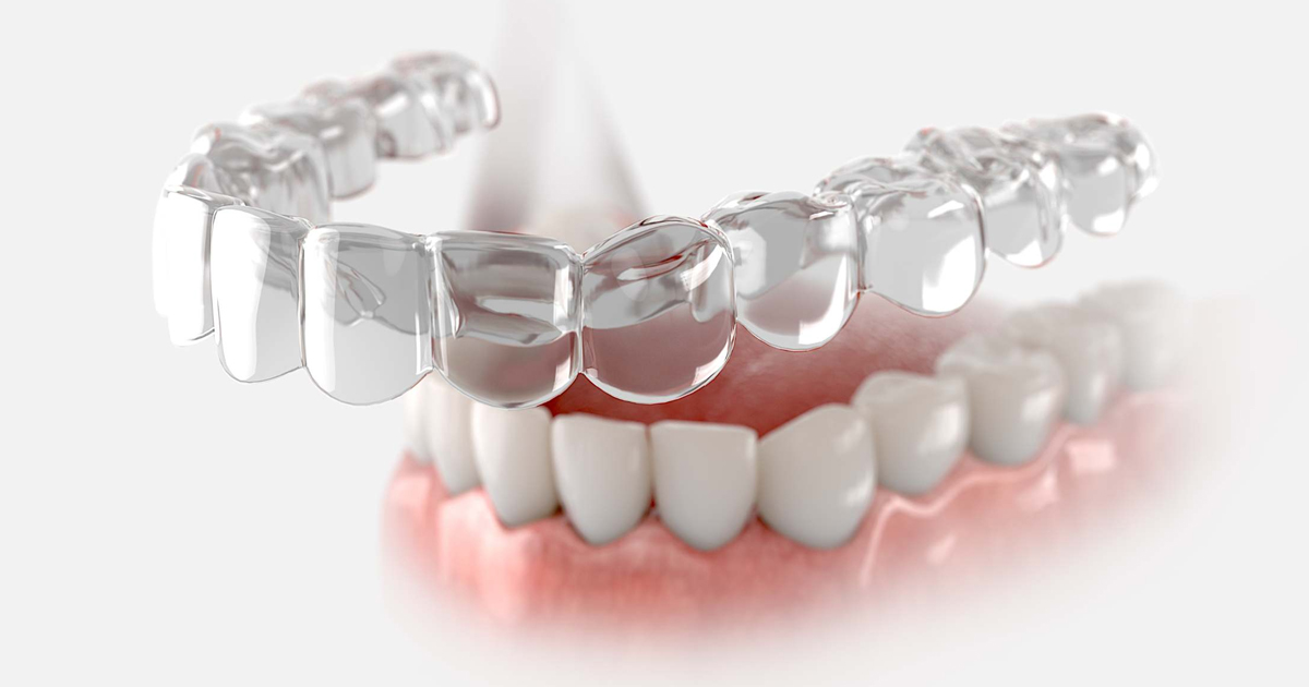 Urgencias de Ortodoncia Invisible Invisalign