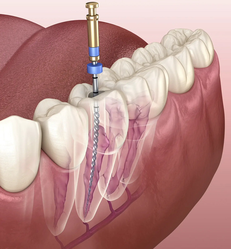 endodoncia guadalajara