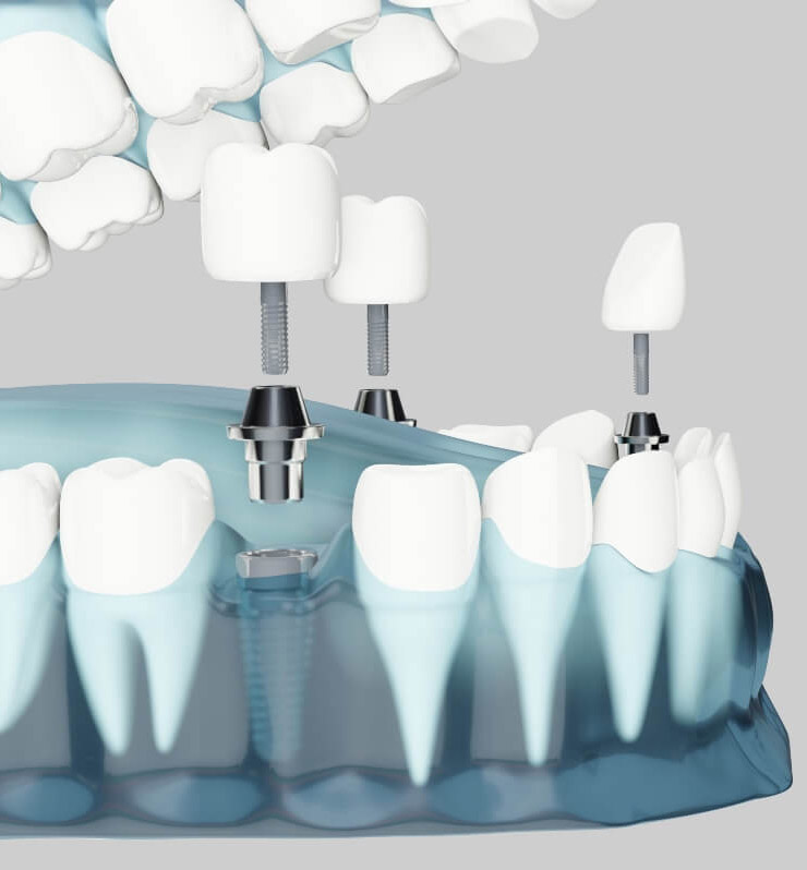 implantes dentales guadalajara